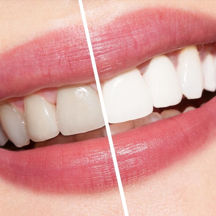 Teeth Whitening Near Me | Petitto Family Dental | Hammond, LA